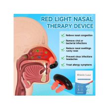 SMART LASER - Rhinitis Nasal Laser Orrkezelő lágylézer készülék 